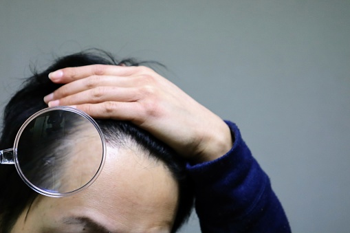 Close-up of a Japanese man suffering from thinning hair