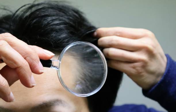 istock Japanese men suffering from thinning hair 1644525384