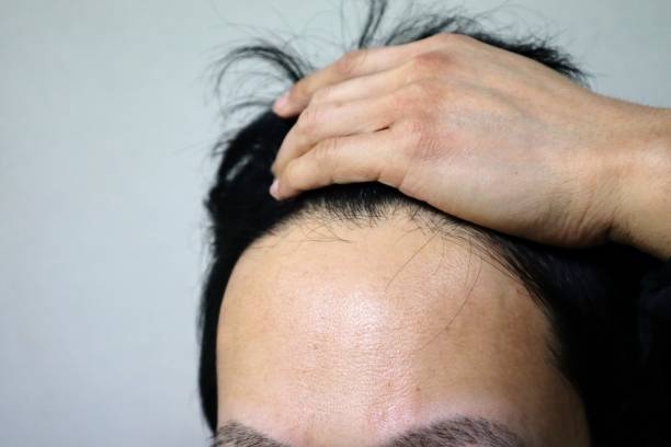 istock Japanese man with thin hair 1644686970