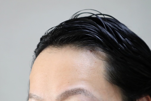 Photo of a Japanese man with thin hair