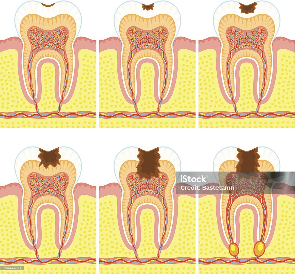 Estructura interna de dientes - arte vectorial de Absceso libre de derechos
