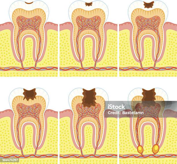 Wewnętrzną Strukturę Zęba - Stockowe grafiki wektorowe i więcej obrazów Anatomia człowieka - Anatomia człowieka, Ból zęba, Choroba