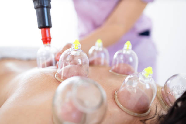 istock Ancient alternative medicine for chronic pain and relaxation. Hijama therapy being performed by professional therapist. Focus on suction cups. 1644969143