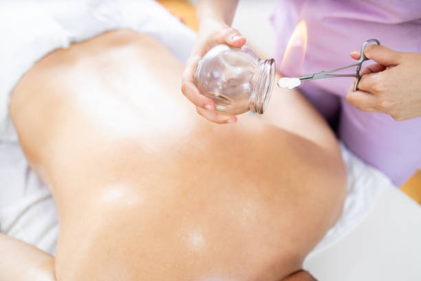 istock Hijama treatment. Heating cup for better suction and vacuum. 1644969654