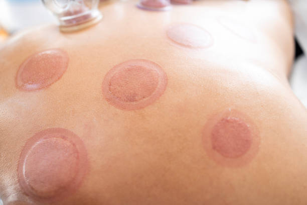 nasse schröpfspuren und schnitte am patienten nach der hijama-behandlung. - acupuncture cupping stock-fotos und bilder