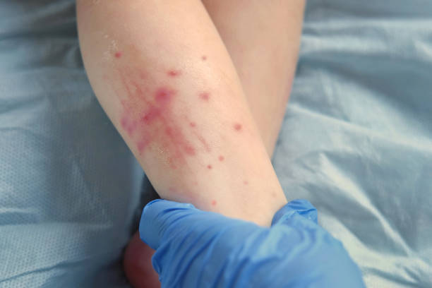 mains du médecin examinant la jambe du nourrisson. allergie au petit enfant. closeup. l’enfant gratte une éruption cutanée rouge. nurse applique une crème spéciale sur les peaux atopiques. dermatite, diathèse, irritation sur le corps du bébé. pru - baby beauty beautiful the human body photos et images de collection