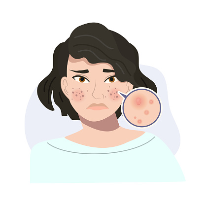 Portrait of Stressed Female with Troubled Skin. Acne, Nodule Skin Close Up. Flat vector cartoon illustration