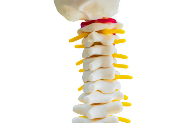 la columna lumbar desplazó el fragmento de hernia discal, el nervio espinal y el hueso. modelo sobre fondo blanco con trayectoria de recorte, para tratamiento médico en el departamento de ortopedia. - slipped disc fotografías e imágenes de stock