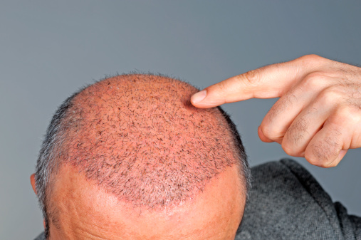 Hair Transplant Stock Photo - Download Image Now - Hair Transplant,  Balding, Beautiful People - iStock