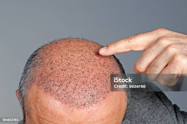 Hair Transplant Stock Photo - Download Image Now - Hair Transplant, Forehead, Transplant Surgery