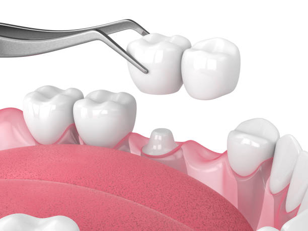 istock 3d render of  jaw with dental cantilever bridge on embedded tooth 1646613521