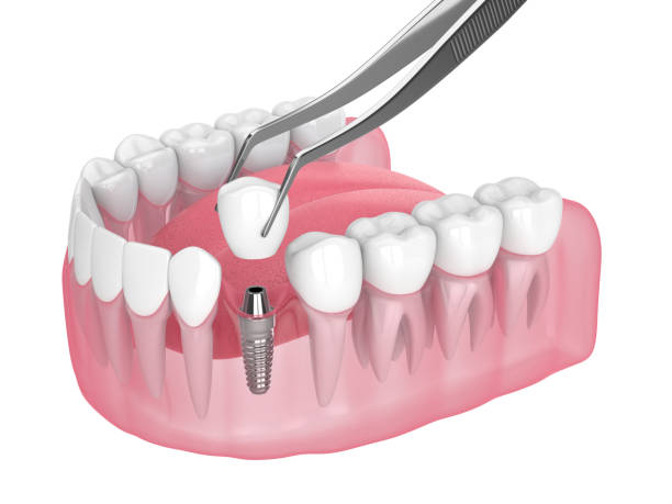 istock 3d render of jaw with dental implant placement 1646613523