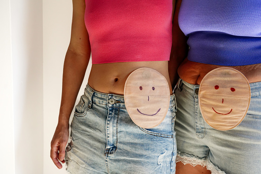 Dos mujeres irreconocibles con cara sonriente en bolsa de colostomía. Pareja con un estoma de un cáncer de colon con alta autoestima photo