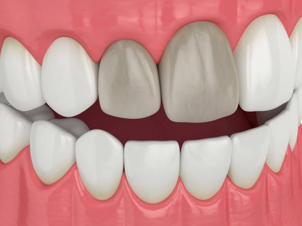 istock 3d render of jaw and teeth with dead pulp 1647735003