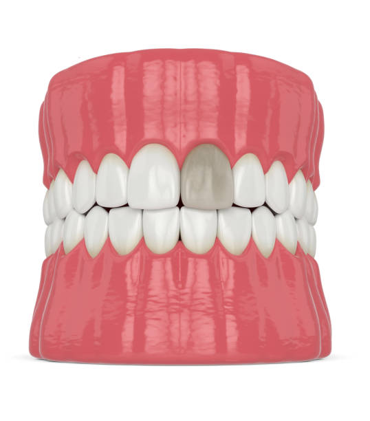 istock 3d render of jaw and tooth with dead pulp 1647787943