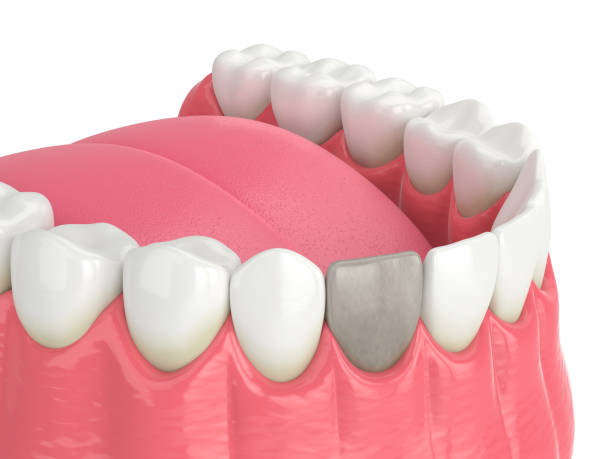 istock 3d render of jaw and tooth with dead pulp 1647787944