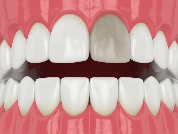istock 3d render of jaw and tooth with dead pulp 1647788448