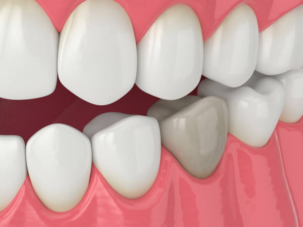 istock 3d render of jaw and tooth with dead pulp 1647788449