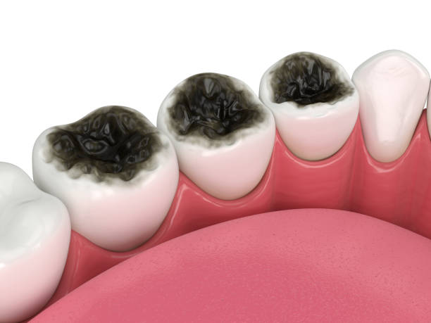 istock 3d render of lower jaw and teeth with caries 1647788453