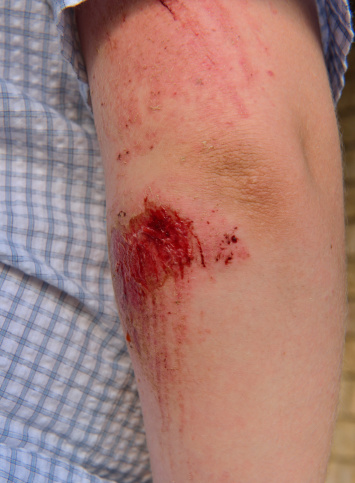 Close up of bloody scrape on child's arm after bicycle accident.