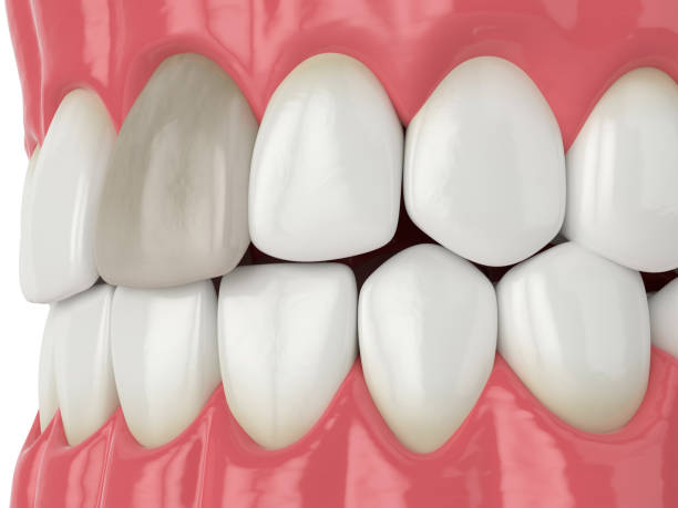 istock 3d render of jaw and tooth with dead pulp 1647980177