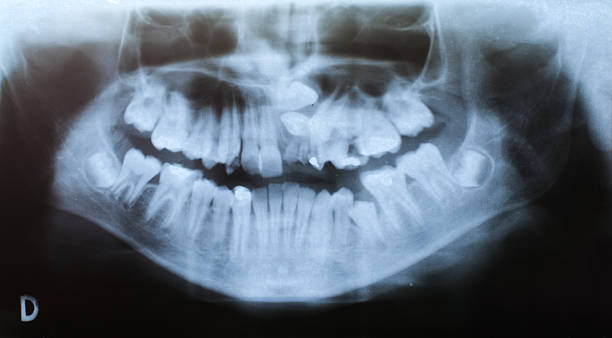 歯の変形 x 線-重大 - deformed ストックフォトと画像