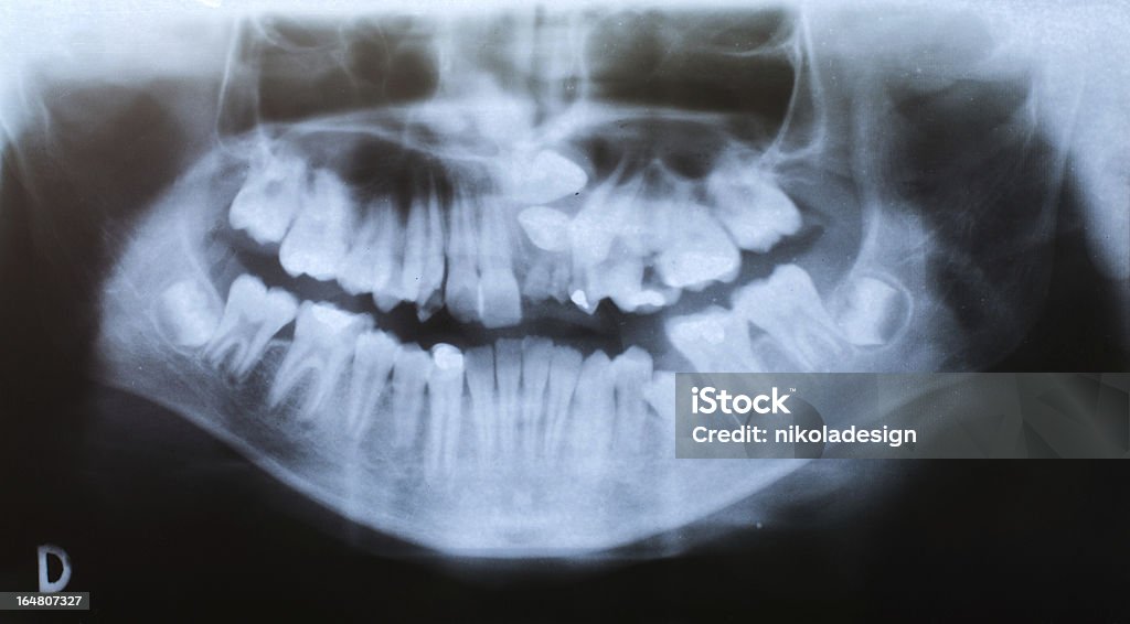 deformation de raio-X odontológico sério - Foto de stock de Deformado royalty-free