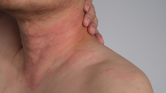 Close up image of skin texture suffering severe urticaria or hives or kaligata on back. Allergy symptoms.