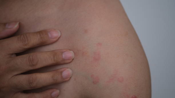 istock Close up image of skin texture suffering severe Allergy. 1649921245