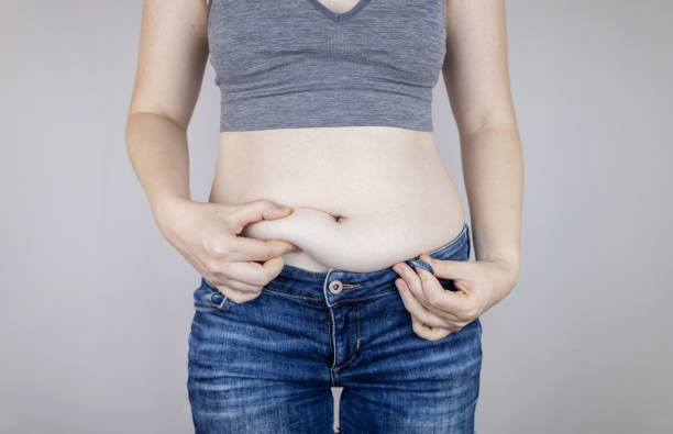 Obesity Cellulite. Folds of excess fat on woman waist. Before and after. Concept of losing weight, playing sports, checking result from diet and intense training. Result of losing weight. Liposuction Liposuction. Obesity Cellulite. Folds of excess fat on woman waist. Before and after. Concept of losing weight, playing sports, checking result from diet and intense training. Result of losing weight. excess fat stock pictures, royalty-free photos & images