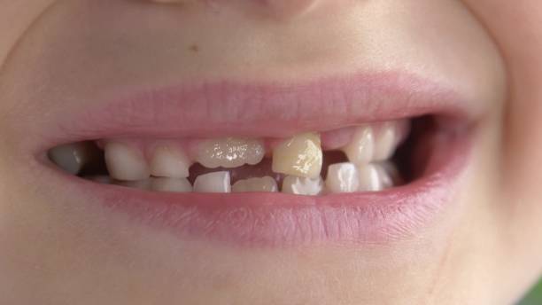 istock Child Loose Tooth Moving Heavily Back and Forth 1650137303