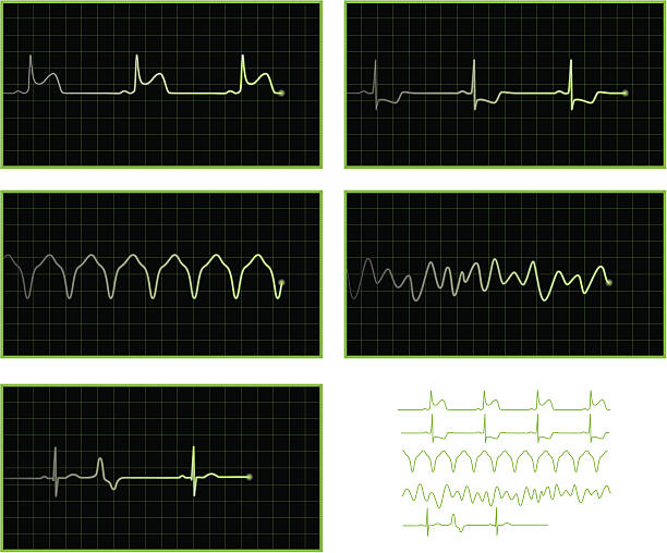 Abnormal ECG waves vector art illustration