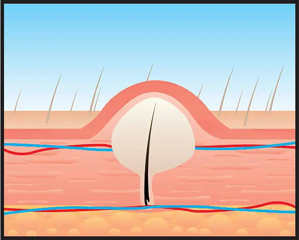 Vector illustration of A diagram of hair growing under the skin