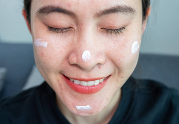 istock Asian woman smiling after she applying acne cream on her face for solving acne problem. 1651888222