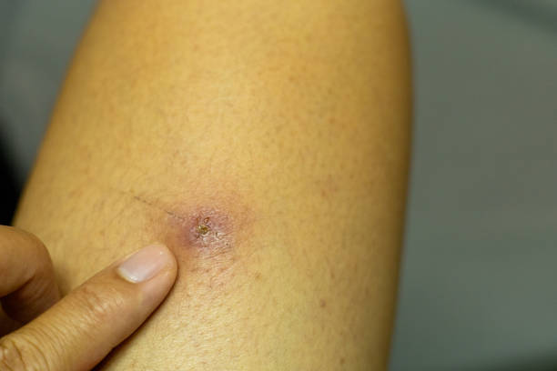 istock The man's leg had a wound that appeared to be inflamed. 1652266728