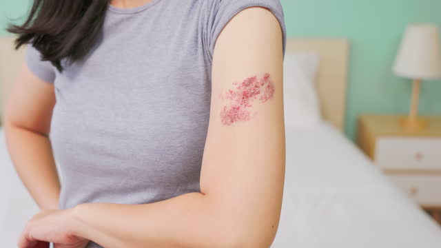 Painful shingles in woman