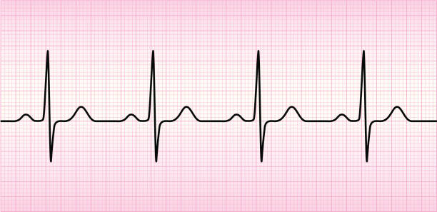 Рисунок кардиограммы здорового человека