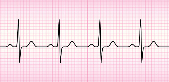 ECG wave on printout paper.