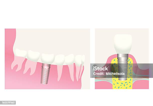치과 임플란트 건강관리와 의술에 대한 스톡 벡터 아트 및 기타 이미지 - 건강관리와 의술, 금속, 단일 객체