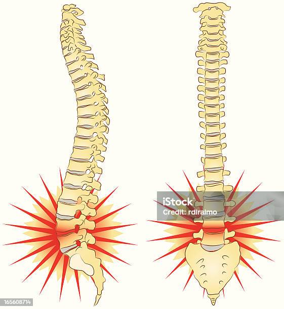 요통 아픔에 대한 스톡 벡터 아트 및 기타 이미지 - 아픔, 탈장, 건강관리와 의술
