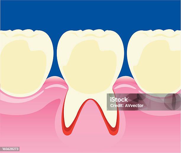 Próchnicy Zębów - Stockowe grafiki wektorowe i więcej obrazów Dziąsła - Dziąsła, Stan zapalny, Anatomia człowieka