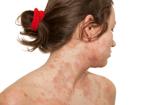 Young girl with Atopic dermatitis,type of eczema,is an inflammatory, chronically relapsing, non-contagious and pruritic skin disease. It has been given names like 