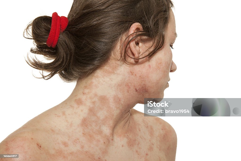 A woman with a skin disorder of atopic dermatitis Young girl with Atopic dermatitis,type of eczema,is an inflammatory, chronically relapsing, non-contagious and pruritic skin disease. It has been given names like "prurigo Besnier," "neurodermitis," "endogenous eczema," "flexural eczema," "infantile eczema," and "prurigo diathsique. Atopic Eczema Stock Photo