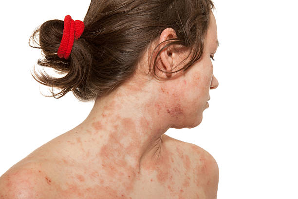 A woman with a skin disorder of atopic dermatitis Young girl with Atopic dermatitis,type of eczema,is an inflammatory, chronically relapsing, non-contagious and pruritic skin disease. It has been given names like "prurigo Besnier," "neurodermitis," "endogenous eczema," "flexural eczema," "infantile eczema," and "prurigo diathsique. dermatitis photos stock pictures, royalty-free photos & images