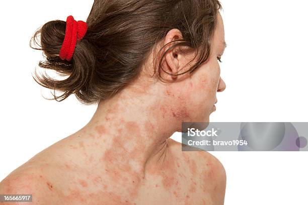 A Woman With A Skin Disorder Of Atopic Dermatitis Stock Photo - Download Image Now - Atopic Eczema, Eczema, Dermatitis