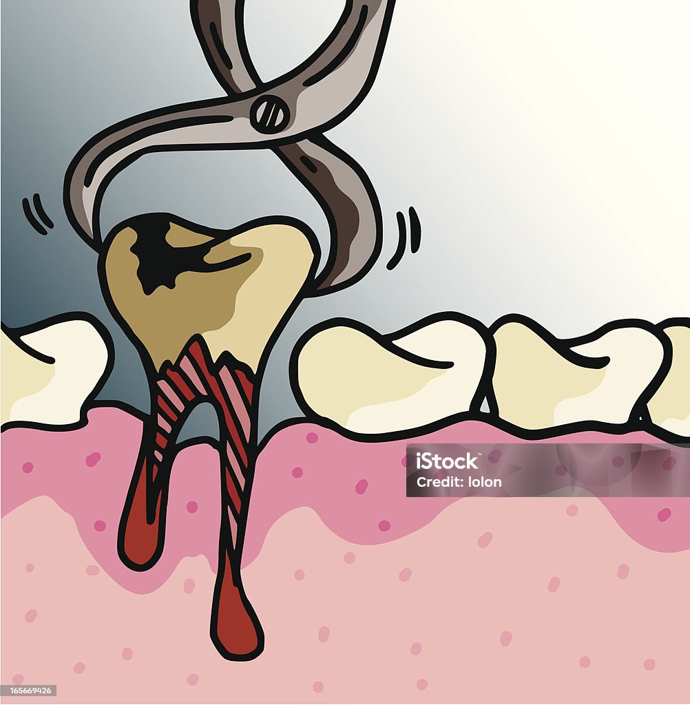 Zahn Extraktion - Lizenzfrei Entfernen Vektorgrafik