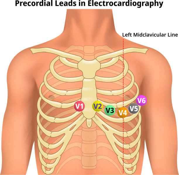 ilustrações, clipart, desenhos animados e ícones de derivações precordiais em eletrocardiografia - v1, v2, v3, v4, v5 e v6 - posição das derivações torácicas no ecg - aparência 3d - electrode