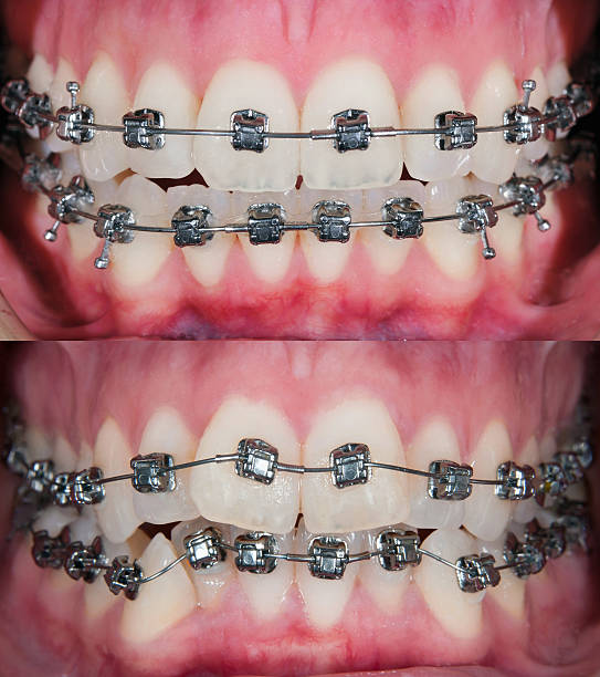Orthodontic Treatment Before & After stock photo