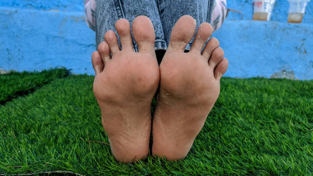 istock Dry flaky foot skin 1657225807