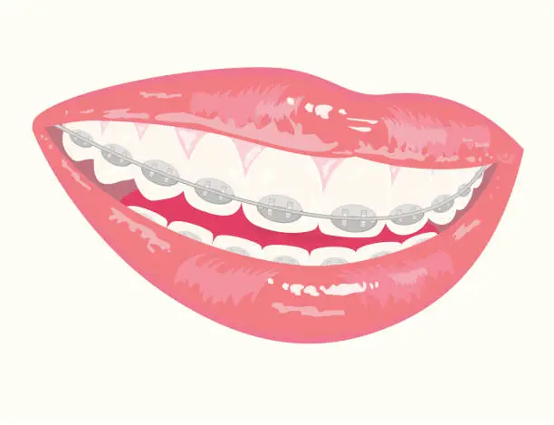 Vector illustration of Smile with Braces